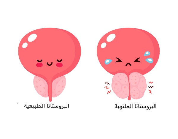 أعراض الإصابة بأمراض البروستات