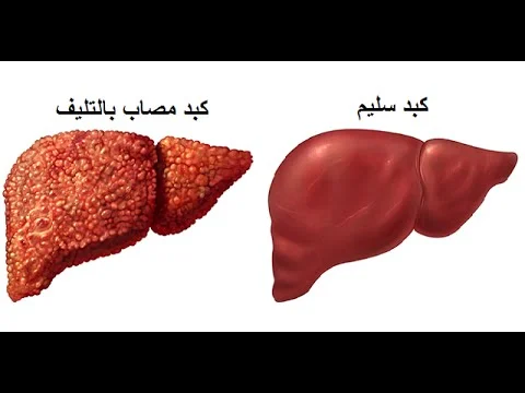 علامات في القدمين تدل على تليف الكبد