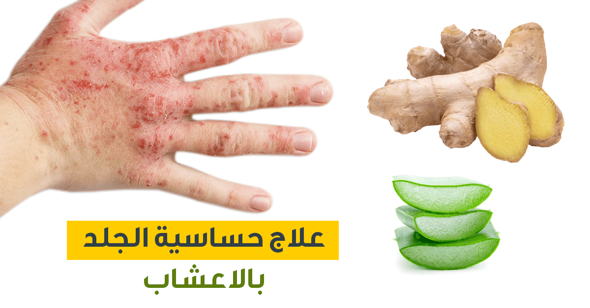 طرق علاج حساسية الجلد بالمنزل