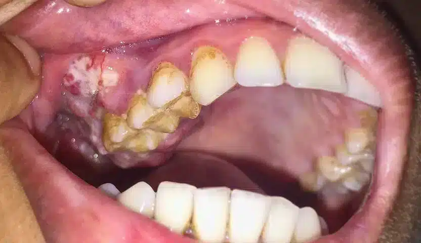 علامات في الفم تدل على سرطان الدم