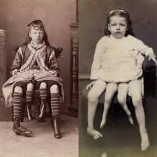 قصة وُلدت فتاة في الولايات المتحدة بأربع أرجل